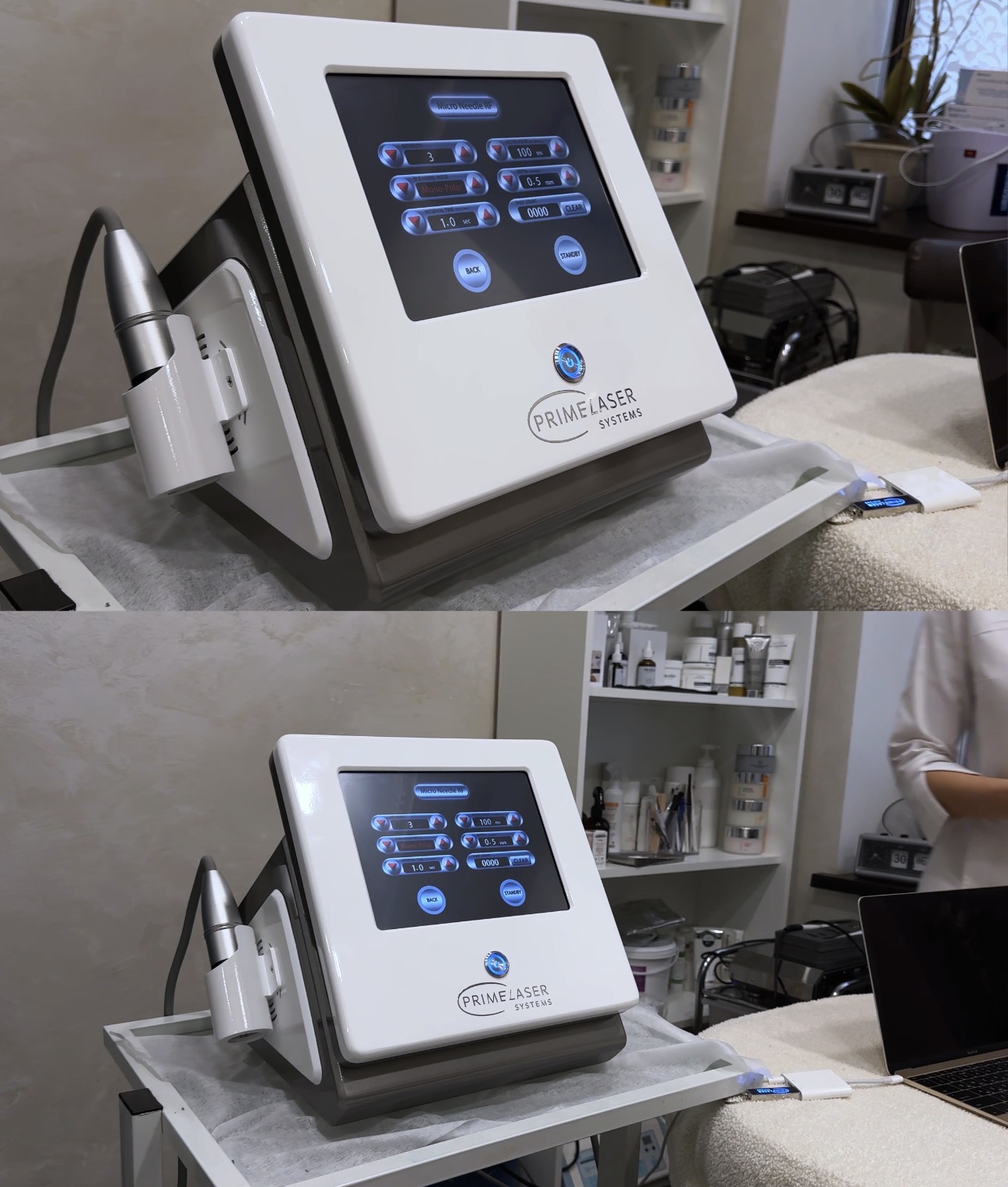 Процедура RF-ліфтингу в La Beaute